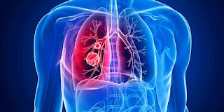 8 Tanda Mengejutkan Dari Kanker Paru-Paru