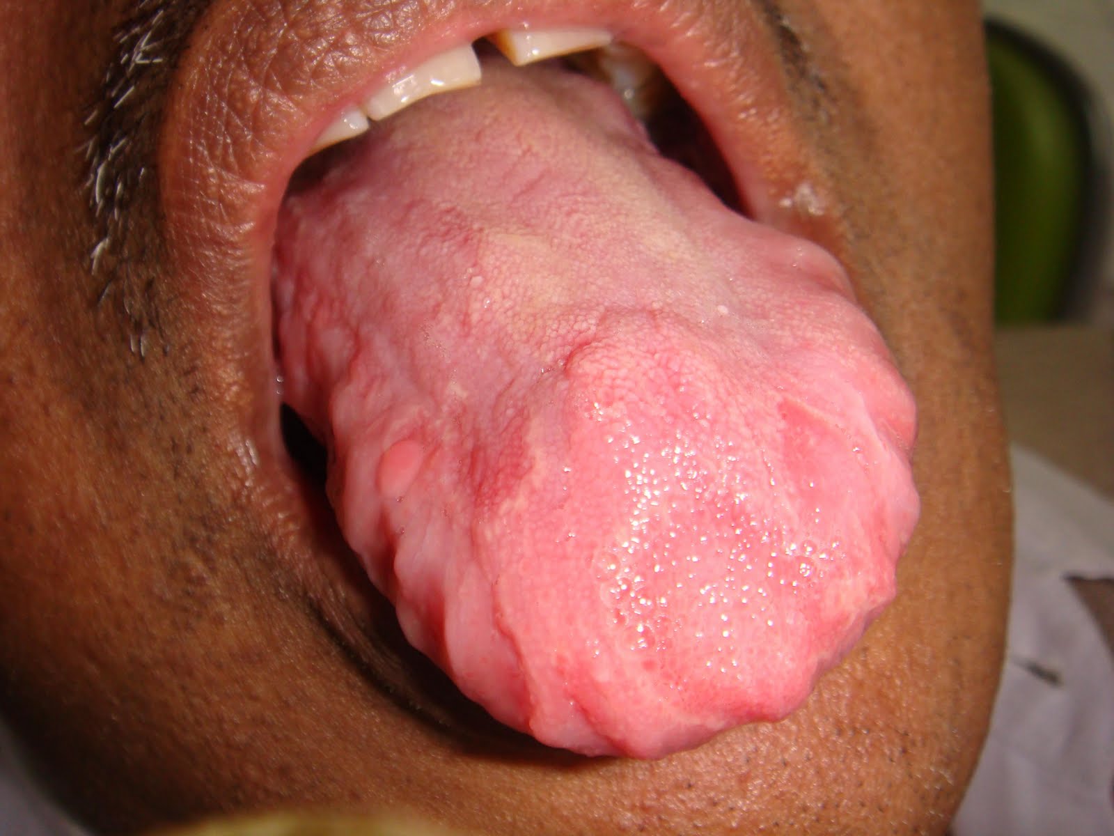 Geographic tongue - Wikipedia