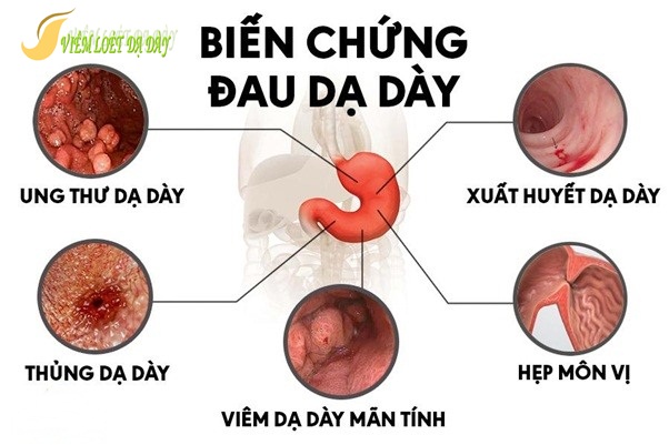 Cac benh ly thuong gap o da day can biet Các bênh lý thường gặp ở dạ dày cần biết