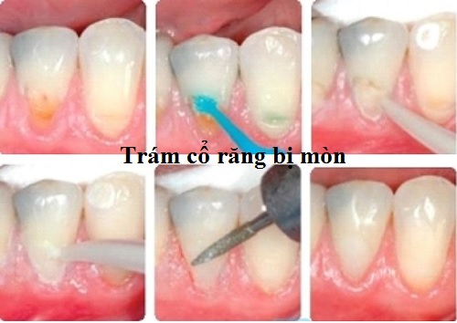 Image result for quy trình trám cổ răng