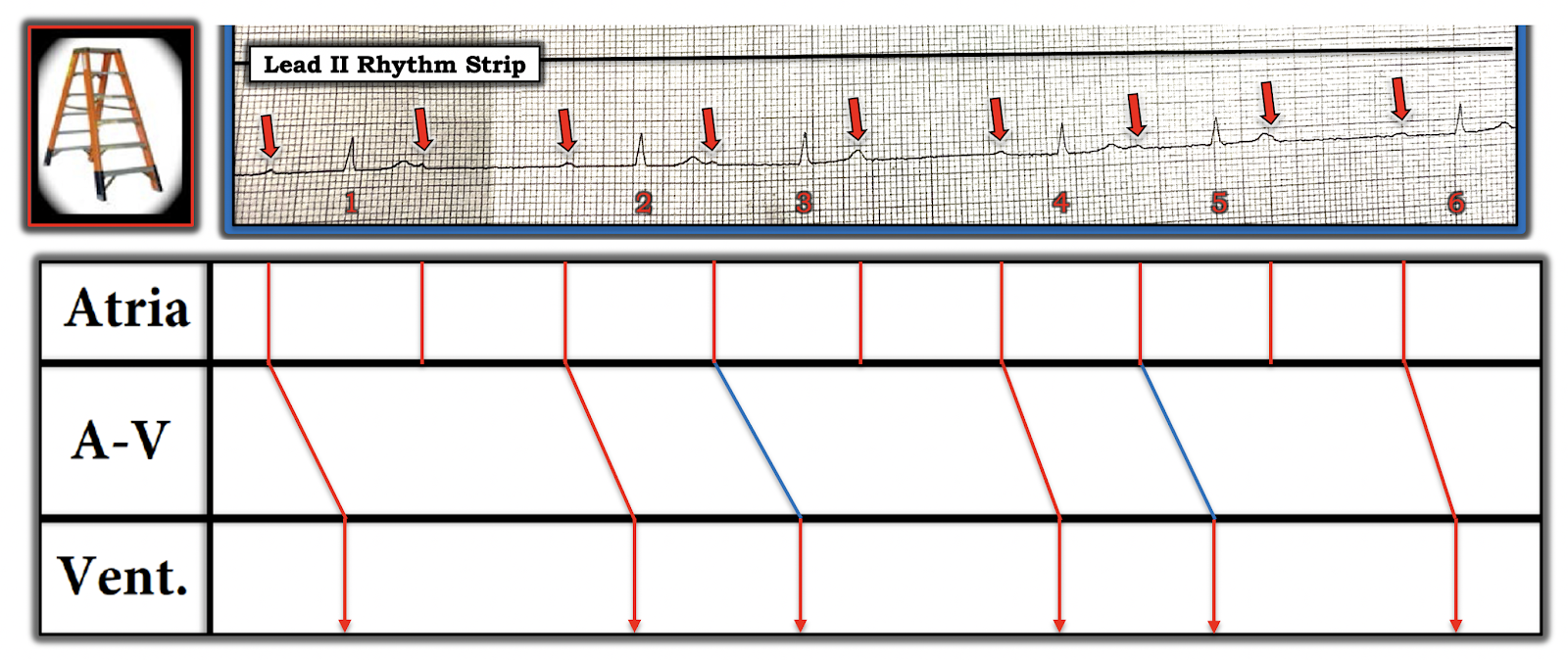 Dr. Smith's ECG Blog Syncope and Chest Pressure, then an Unusual
