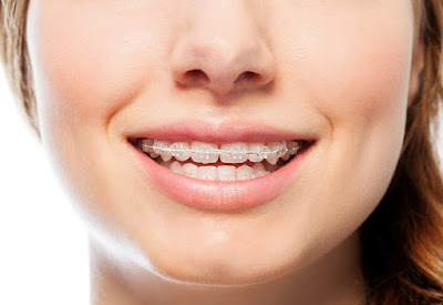 niềng răng không nhổ răng trong trường hợp nào? 3