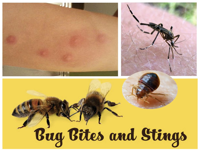Bug bites