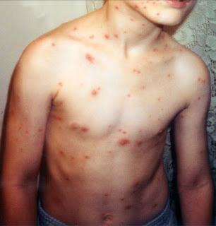 Suçiçeği hastalığına yakalanmış bir çocuk