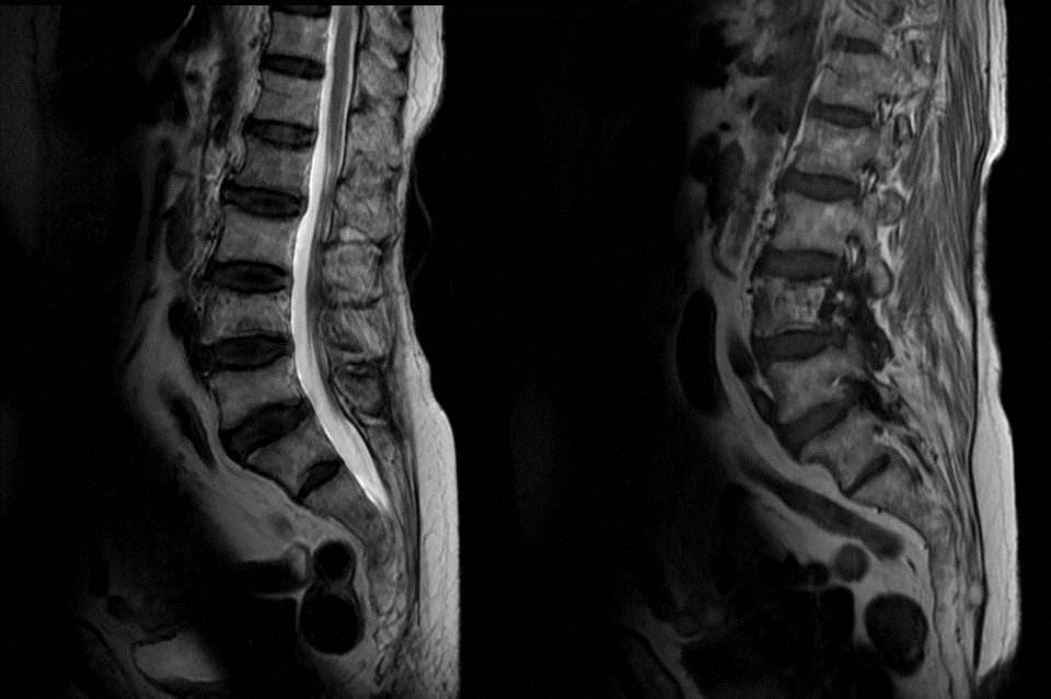 Radshare PAGET'S DISEASE