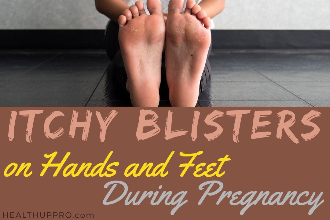 Itchy Palms And Feet Pregnancy / Cholestasis When Being Itchy During