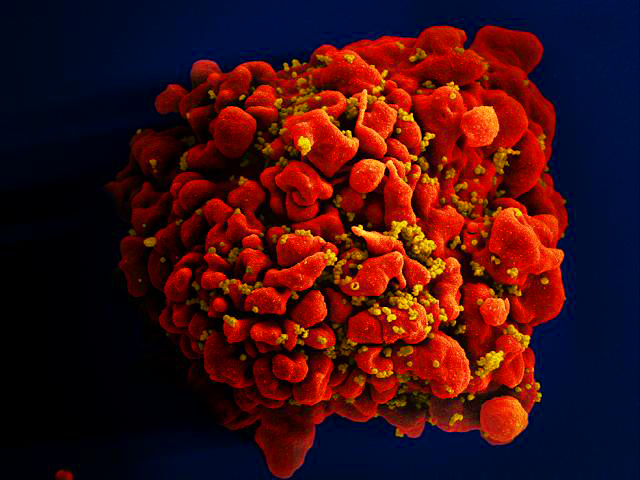 Segunda paciente com HIV pode ter se curado da infecção sem tratamento; entenda