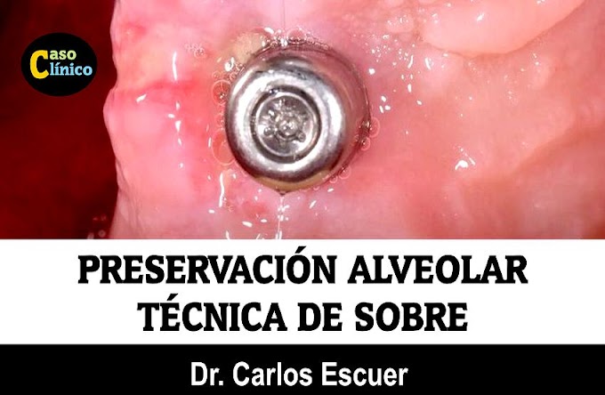PRESERVACIÓN ALVEOLAR: Técnica de Sobre - Dr. Carlos Escuer