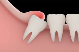 inflamed gums over wisdom tooth