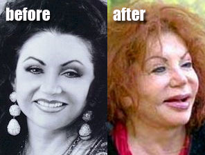 Jackie Stallone Plastic Surgery Before and After Cheek Implants ...