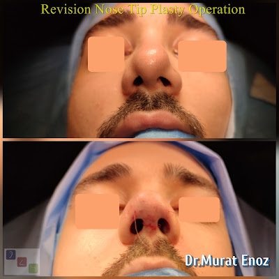 revision nose tip cosmetic surgery,revision nose tip plasty in istanbul,nose tip plasty in istanbul,risks of nose tip plasty,complications after the nose tip plasty,Tip Plasty in Istanbul,