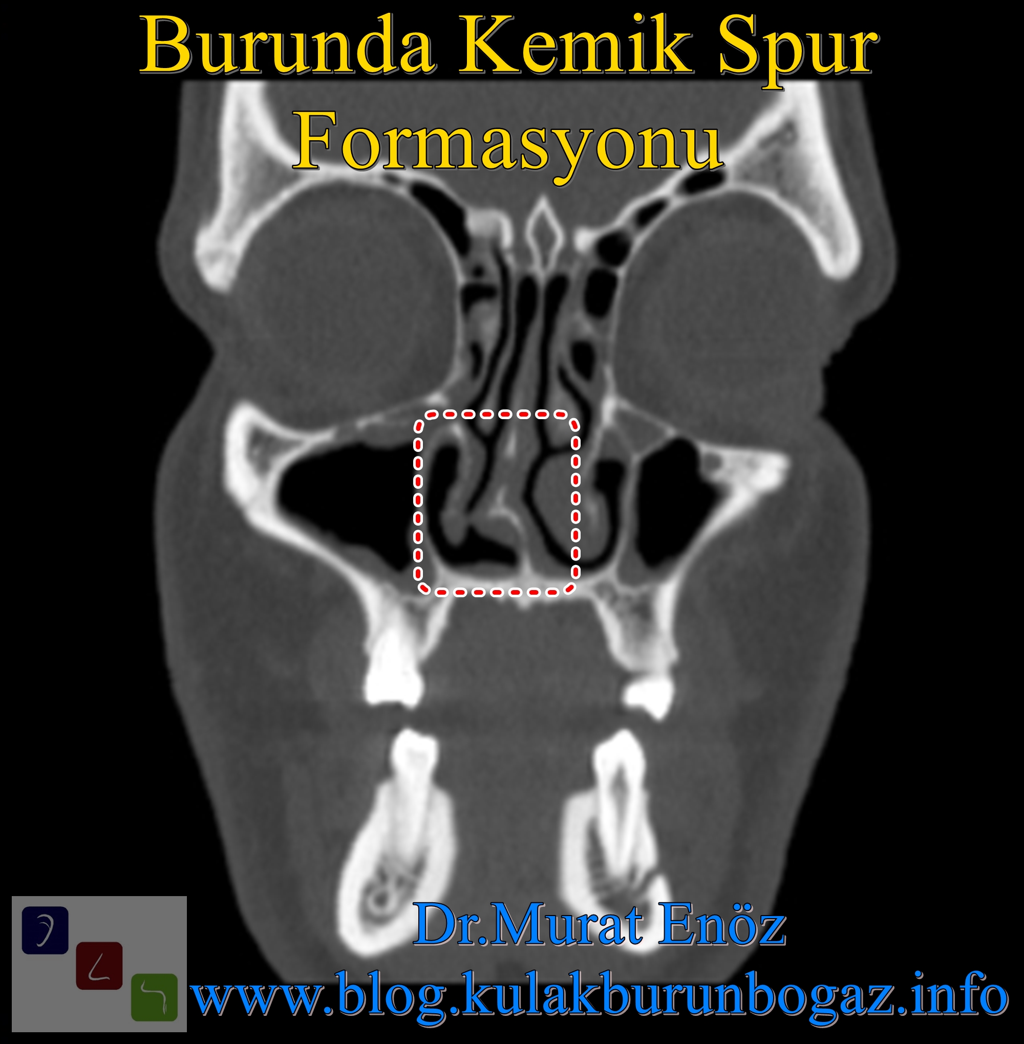Health Zone Turkey Nasal Bone Spur Symptoms, Diagnosis, Treatment