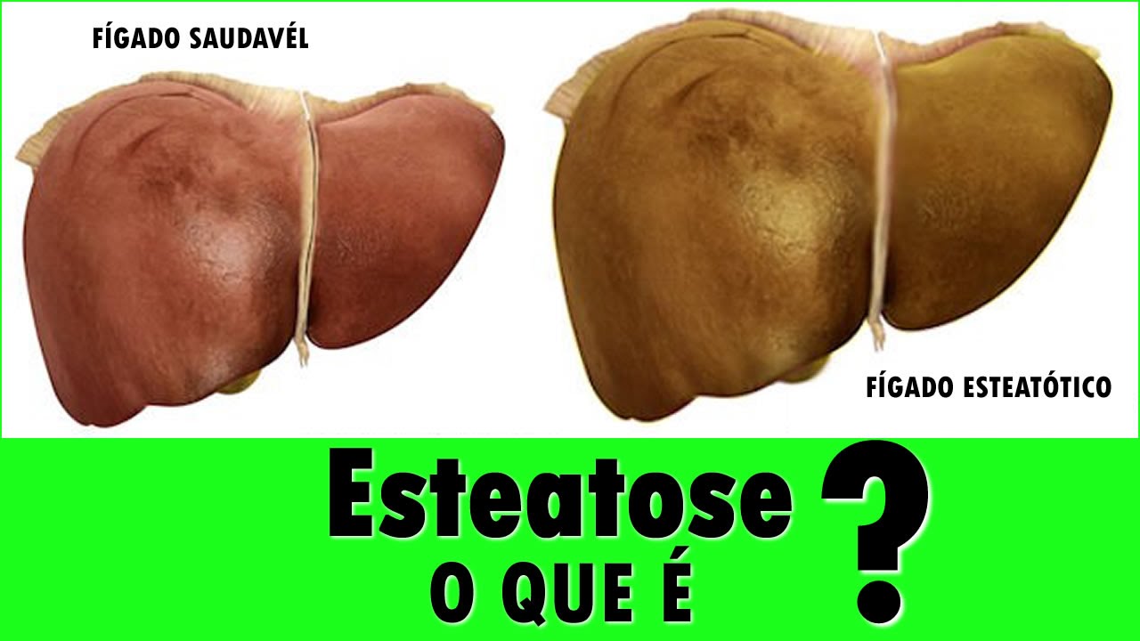 Atlas virtual de histologia e patologia [CC 7] ESTEATOSE HEPÁTICA
