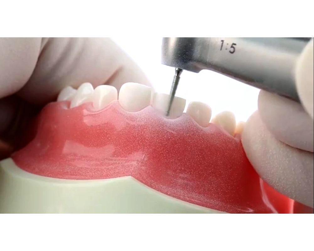 Pediatric Zirconia Crown Technique Anterior and Posterior OdontoVida