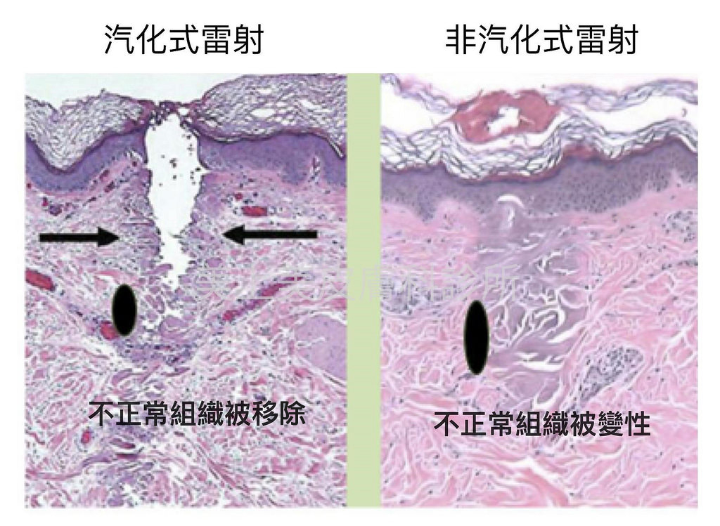PicoSure755皮秒雷射蜂巢式聚焦陣列透鏡蜂巢皮秒雷射雀斑痘疤毛孔細紋新竹推薦林亮辰皮膚專科診所林亮辰醫師UP雷射UltraPulse痘疤凹疤痘疤淡化凹疤修復凹疤ptt凹洞治療費用