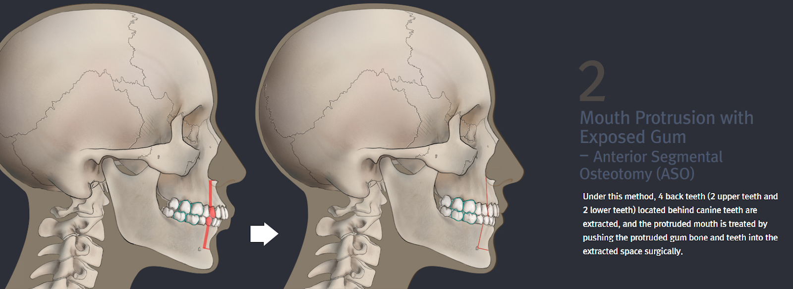 Protruding mouth & Anterior Segmental Osteotomy (ASO)_EU