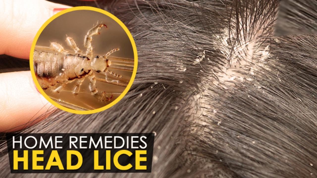 Natural Way To Get Rid Of Chicken Lice Natural Way To Get Rid Of Chicken Lice