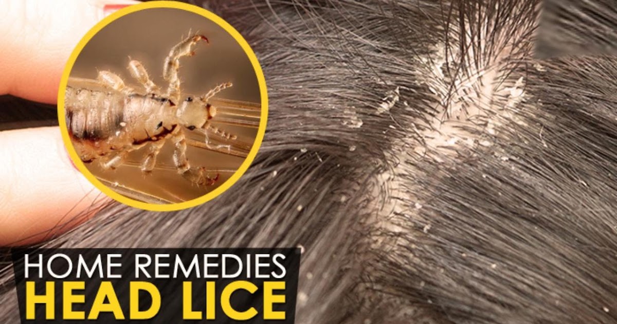 Doctors Won't Tell You This Cheap Way to Get Rid of the Head Lice Quickly