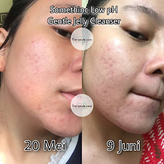 before after Somethinc Low pH Gentle Jelly Cleanser