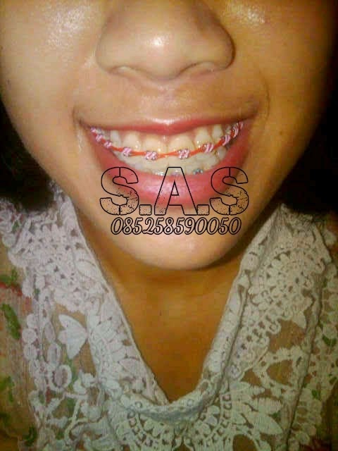 Foto Cewek Cantik Berbehel S A S Dental Foto Cewek Cantik Berbehel S A S Dental
