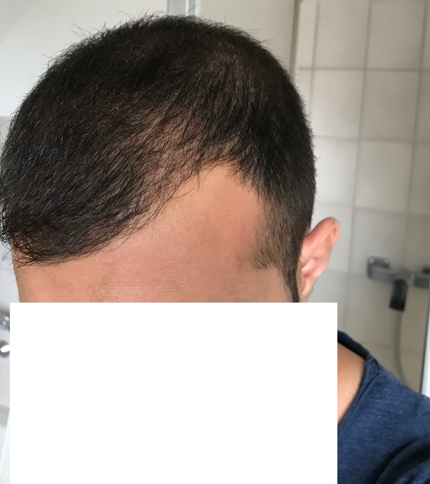 Monaten haartransplantation nach 4 ▷ Heilung