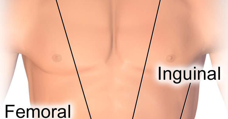 What Is Hernia Swami Dayanand Naturopathy Hospital