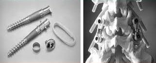 Spine Update 脊椎新事: DYNAMIC STABILIZATION?