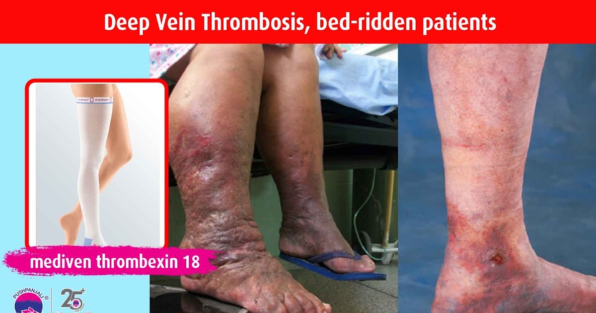 Clinical Compression stockings for treatment of Deep Vein Thrombosis
