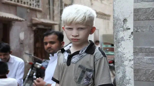 Maladie héréditaire et congénitale, albinisme