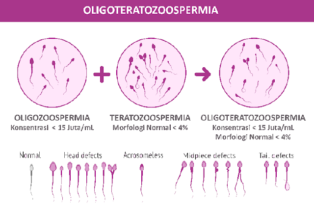 Hasil Tes Sperma OligoTeratozoospermia
