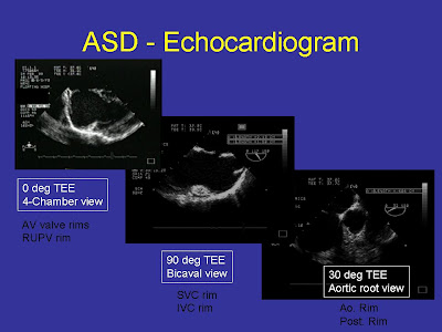 Pedi cardiology: Echo: ASD, TEE evaluation of rims for Transcatheter ...