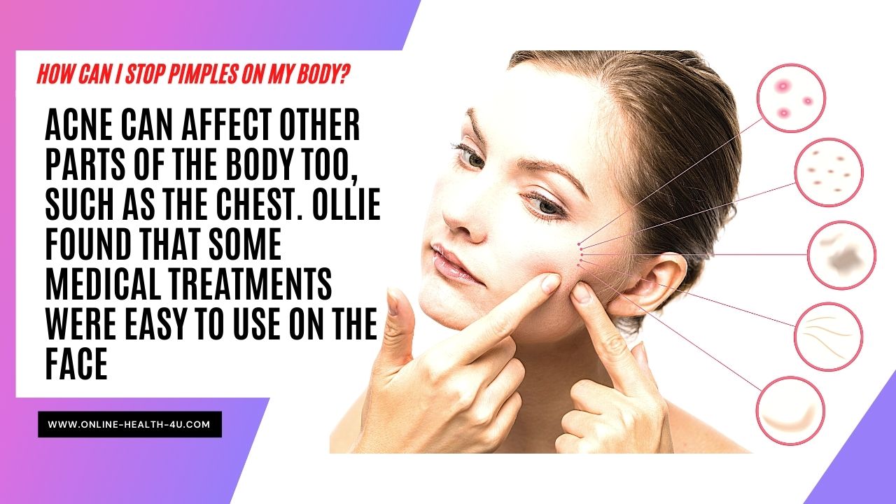 what-causes-pimples-how-to-treat-and-prevent-it-2021