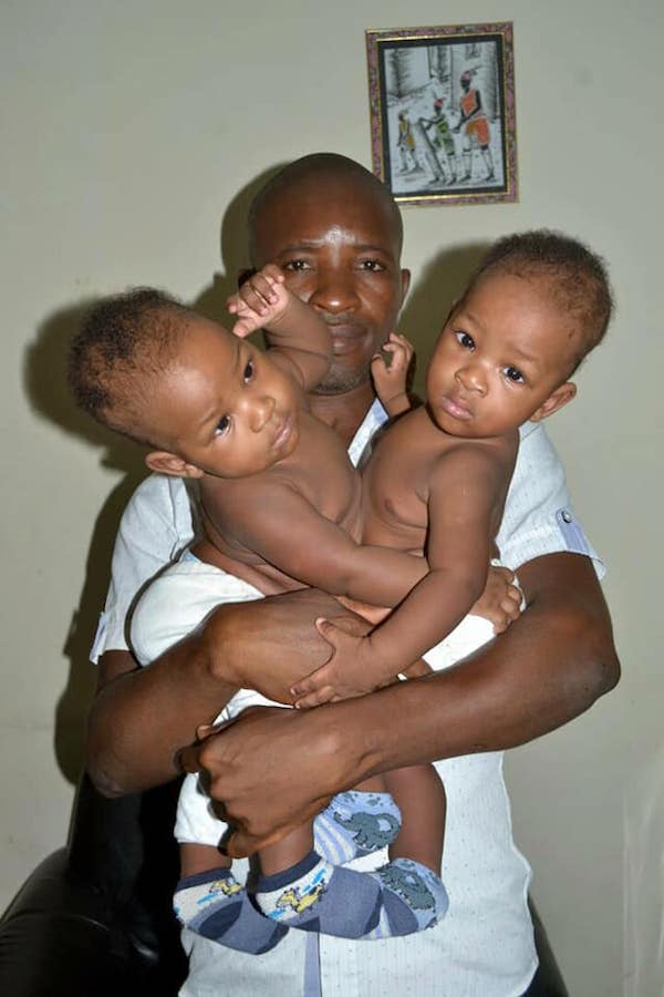 Amazing Conjoined Nigerian Twins Got Separated By 22 Specialists