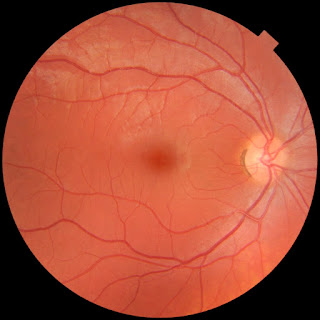 An image of the retina. 