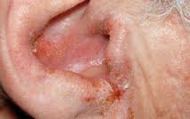 Otitis Ekterna Alternatif Pengobatan