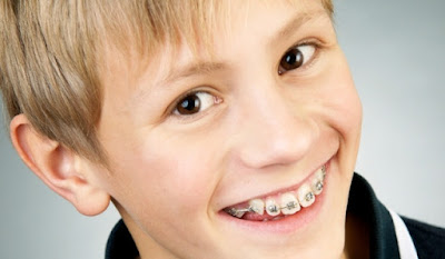 Niềng răng không nhổ răng áp dụng được khi nào?