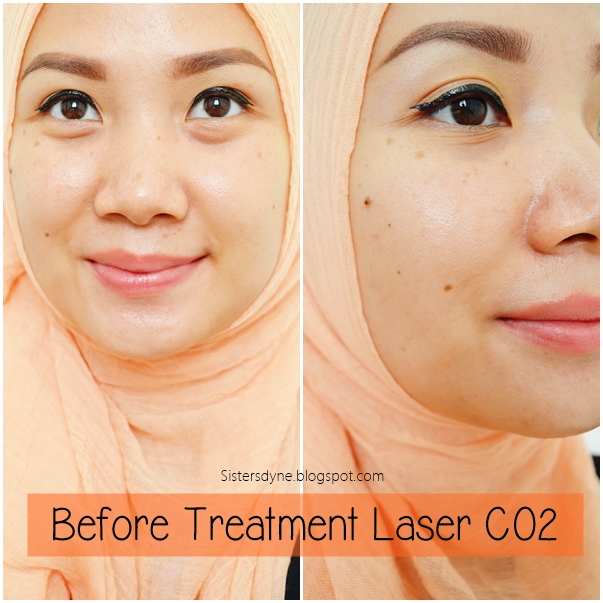 Harga Laser Co2 Di Erha 2018 Terbaru