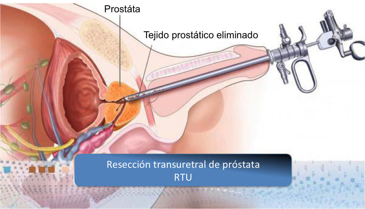 Consecințele hiperplaziei prostatice