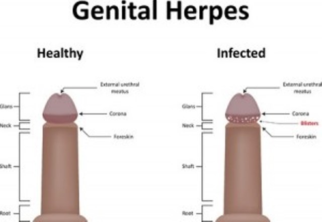 What Does A Herpes Bump Look Like – The Body