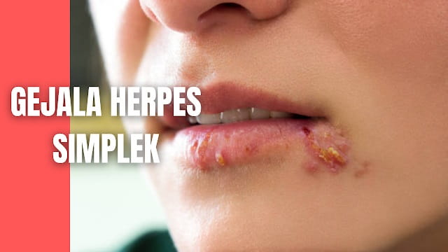 Herpes nariz causas