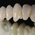 Cách khắc phục bọc răng sứ bị viêm lợi