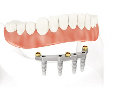 Dịch vụ trồng răng implant ở cần thơ-2