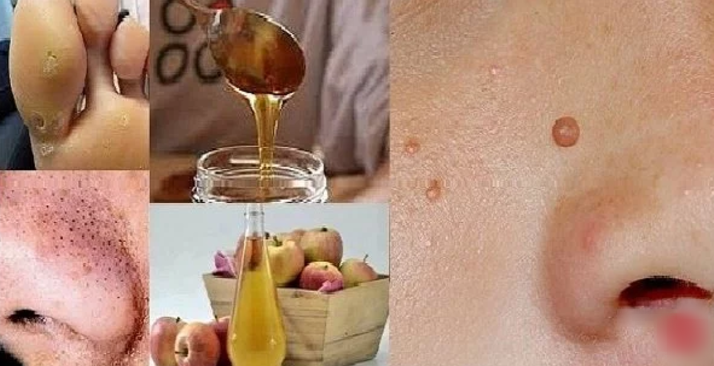 Here's How To Naturally Get Rid Of Warts, Blackheads, Brown Spots..etc!