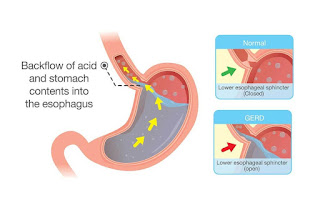 CARA PENGOBATAN GERD DENGAN OBAT ALAMI AMPUH