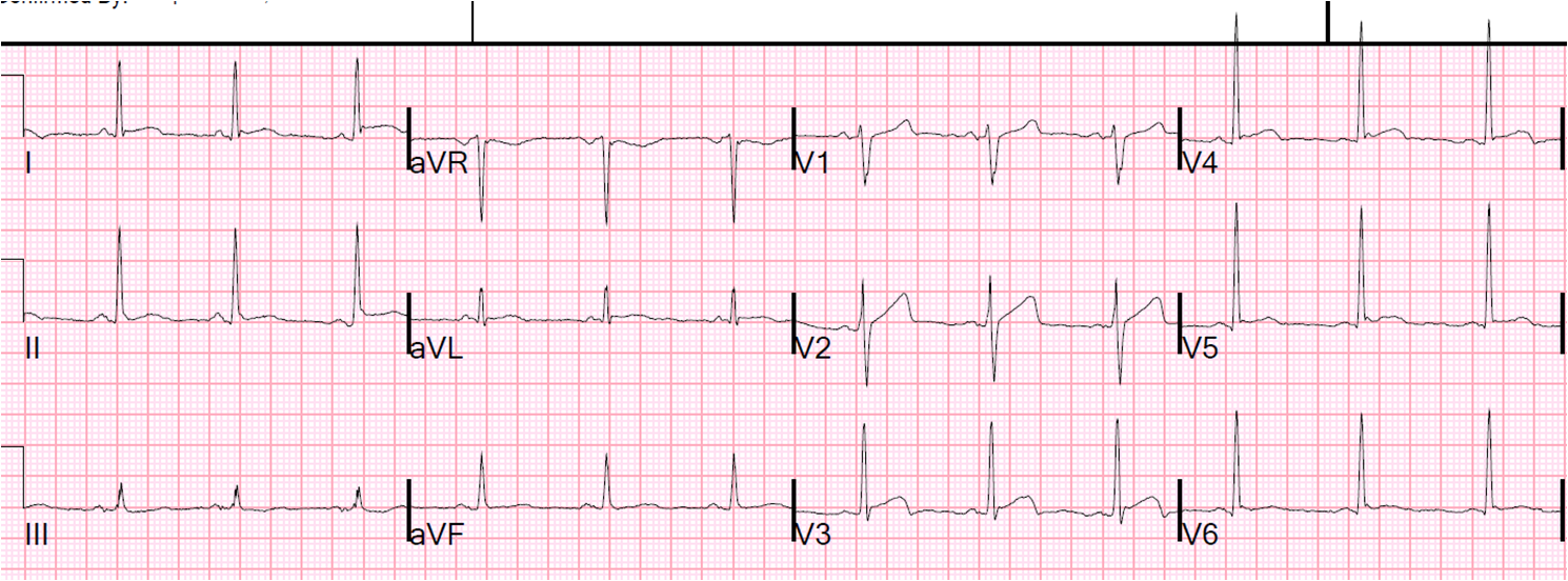 Wellen waves ecg wellens syndrome stemi winter criteria rebel week rebelem before Dr. Smith's ECG Blog: Is it Wellens' Syndrome?