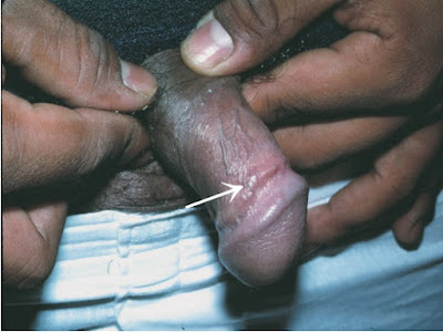 Sclerosing lymphangitis of the penis (arrow).  
