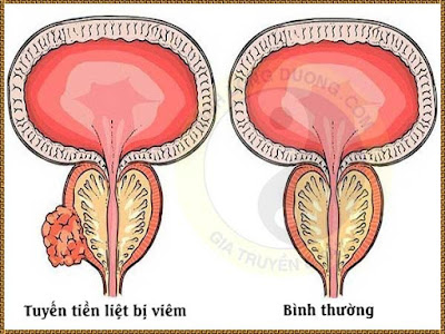 tuyến tiền liệt
