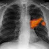 Καρκίνος του πνεύμονα, αιτίες που τον προκαλούν και ποια μπορεί να είναι τα συμπτώματα; 