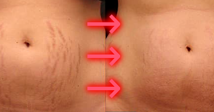 メデルマで 肉割れ 妊娠線 を消したい 完全解説ガイド メデルマ完全解説ガイド