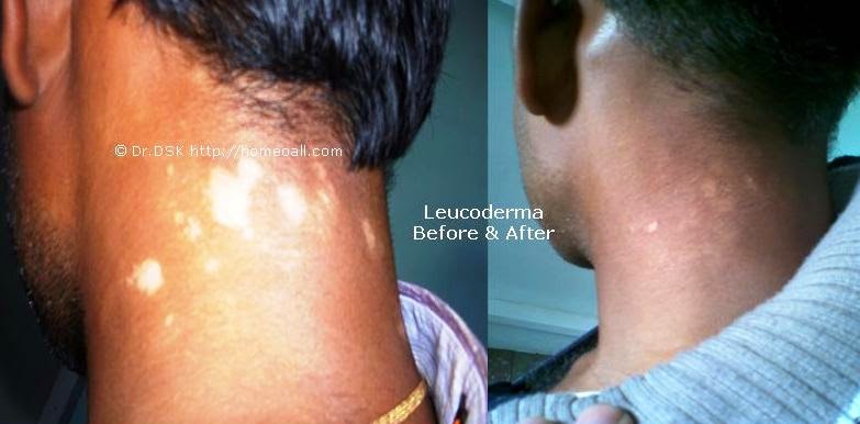  Chennai Specialty Treatment Clinic for Vitiligo, Leucoderma, Velachery, Chennai, Tamil nadu, India 
